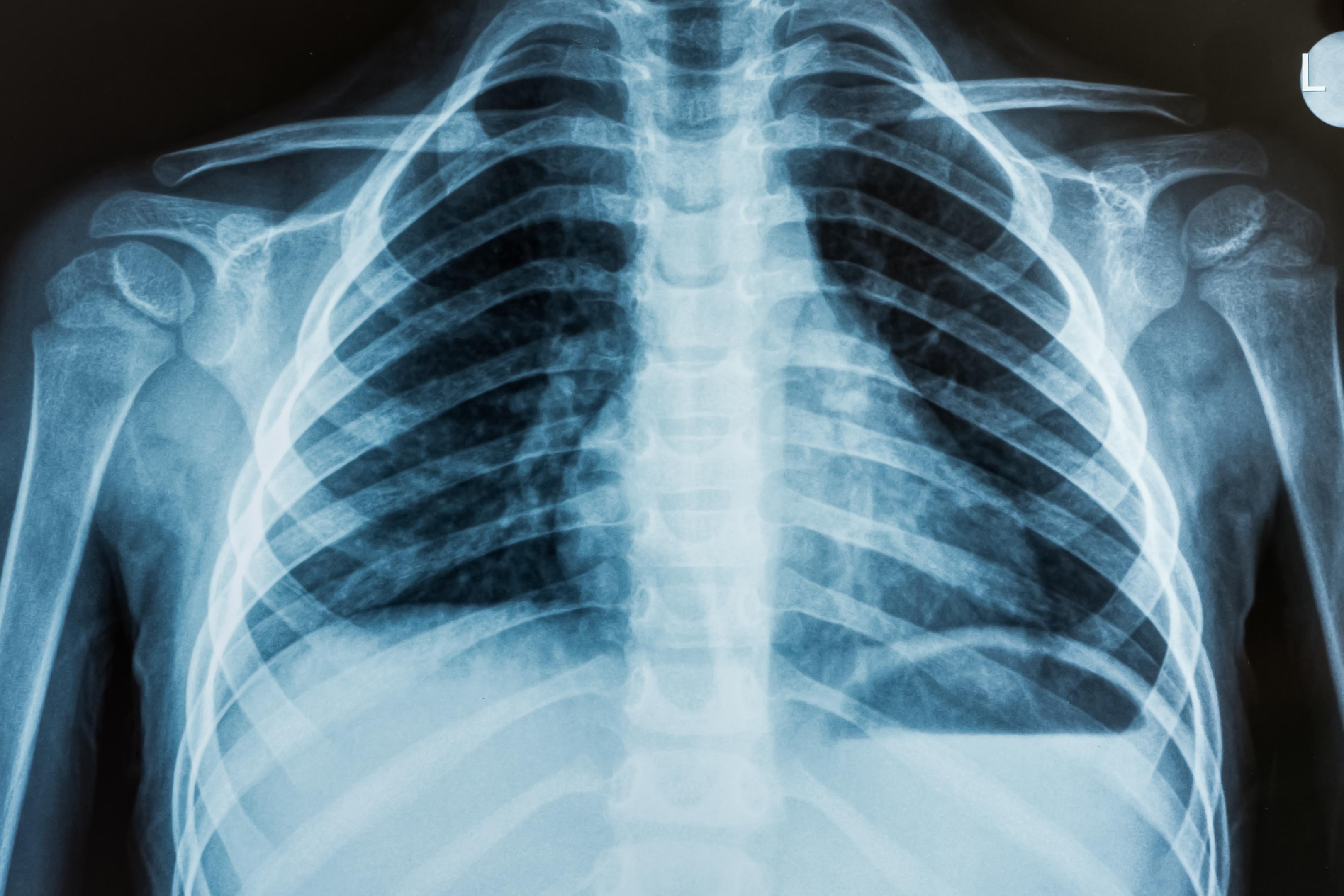 Chest X-Ray Classification Project